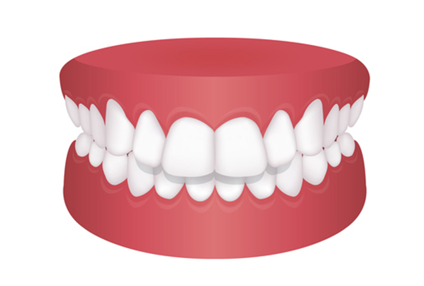 Overbite