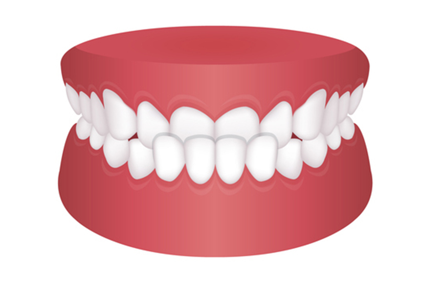 Underbite