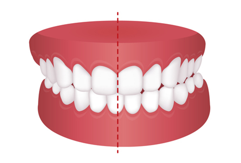 Crossbite
